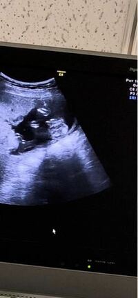 いま妊娠中の者です 妊娠18wでの胎児のエコー写真なのですが Yahoo 知恵袋