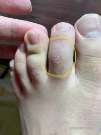 最近左足の人差し指だけがカサついていて 水虫なのかと心配してます 間 Yahoo 知恵袋