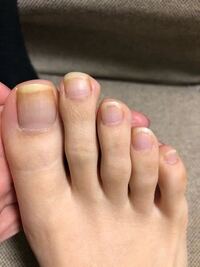 画像あり 足の爪が汚いけどフットネイルに行ってみたいです 画像のとおり爪 Yahoo 知恵袋