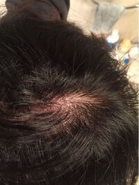 勃起不全のcptコードに対する衝撃波療法