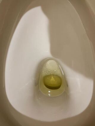 汚い画像ですみません 高校生です この尿の泡は正常のものでしょうか 少 Yahoo 知恵袋