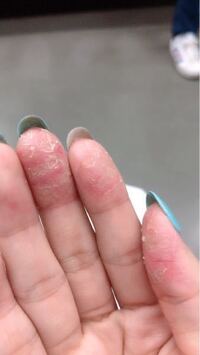 閲覧注意指先がずっと荒れています 右手親指 人差し指 薬指 左手中指 Yahoo 知恵袋