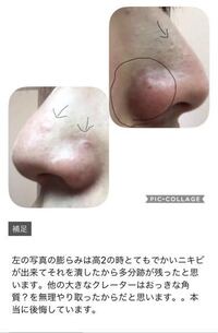 鼻の毛穴の黒ずみが洗顔後は消えるのですが 化粧水や乳液などをつけ終 Yahoo 知恵袋