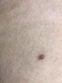 脇腹あたりにできているのですがこれはホクロですか 癌ですか Yahoo 知恵袋