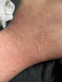 湿疹 手の甲 左手甲の血管に沿って湿疹／皮膚科について