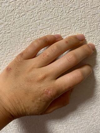 手の荒れがひどいです 痒いし痛いです バイトで洗い物しています 薬や Yahoo 知恵袋