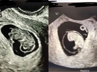 エコー写真について 首後ろのnt むくみ についてですが 下記のエコー写真の赤 Yahoo 知恵袋