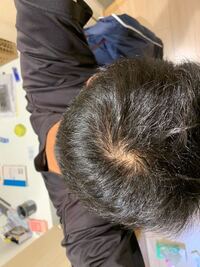 最近つむじハゲではないかとすごく気になっています つむじハゲかどうか良ければ皆 Yahoo 知恵袋