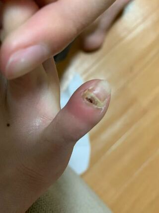 足の小指がひょうそで病院でやいてもらって一ヶ月ほど経つのですが腫れと爪が変なこ Yahoo 知恵袋
