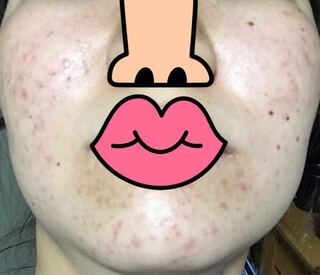 ニキビ跡が酷くて全然治りません 顔全体にあってほんとうにストレスです 自分が他 Yahoo 知恵袋