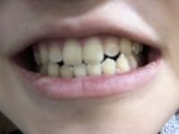 今 歯がとても黄色いのです 小学生の時 男の子から お前の歯 真っ黄 Yahoo 知恵袋
