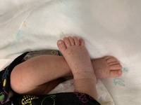 新生児の脚の湿疹について 足の裏一面と表面に赤い斑点 のようなものが Yahoo 知恵袋