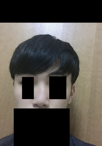 小学生の時に喧嘩して鼻を殴られ画像のように曲がってしまいました 自分は鼻が曲が Yahoo 知恵袋