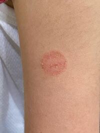 3歳の子どもの腕に一円玉ほどの大きさの赤い発疹が３週間ほど前にできました 本人 Yahoo 知恵袋