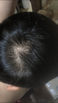 これはハゲているのでしょうか それともつむじが二つあるだけなのでしょ Yahoo 知恵袋