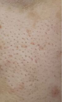 この頬の毛穴を目立たなくするにはどうすればいいですか Yahoo 知恵袋