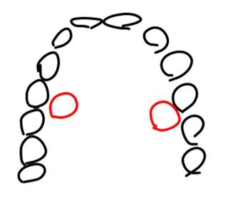 受け口で悩んでいます 受け口と言っても顎が出てしゃくれている訳ではありません Yahoo 知恵袋