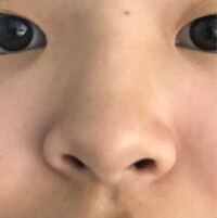 ニンニク鼻とはどのような形なのでしょうか 私の鼻はニンニク鼻ですか 画像 Yahoo 知恵袋
