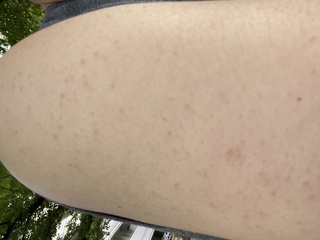 腕のブツブツについてこんにちは 写真の状態の原因か 同じ症状の方がお Yahoo 知恵袋