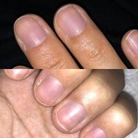 これ爪の色悪いですか 最近ご飯食べてなくて紫っぽくなったんですけど Yahoo 知恵袋