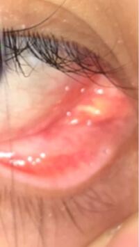 目の内側に白い線のようなものができて かゆいです Yahoo 知恵袋