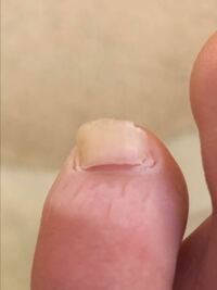 根元から剥がれる 足の爪 爪が根元から割れる原因…大人と子供とで原因が違う