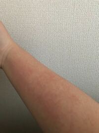 腕にこんな感じの蕁麻疹ができたのですが 原因はなんなのでしょうか 昨 Yahoo 知恵袋
