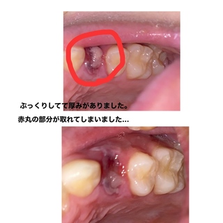 血餅 がとれた 写真グロ注意 口腔内の写真がありますわたしは矯正の Yahoo 知恵袋