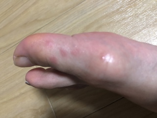 数日前から足親指やその裏に赤い斑点があります 痛くも痒くもない為 よ Yahoo 知恵袋