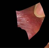 腫れる びら かゆい びら 片方 小陰唇（ビラビラ）が黒い!?黒くなる原因と治療法について