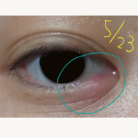 ものもらいか何かでしょうか 5日くらい前から右目の目頭の方が少し赤く Yahoo 知恵袋
