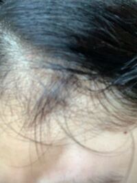 眉毛を剃るときに 前髪の生え際を剃刀で添っちゃって アンド Yahoo 知恵袋