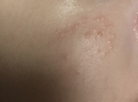 生後2ヶ月から頬に湿疹ができ 家にあったロコイダン軟膏を使用して少し良くなった Yahoo 知恵袋