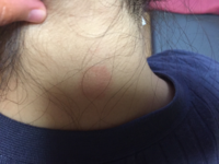 急にこんなアザの様なものができてました 首の後ろです 何かわか Yahoo 知恵袋