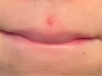 画像あり 口の上にニキビが出来てしまいました 鼻の下を伸ばしたり少し手が当た Yahoo 知恵袋