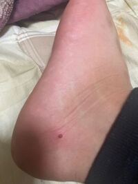 この粒見たいなやつって血豆ですかね Yahoo 知恵袋