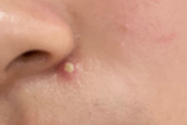 手伝う 配管工 なる 鼻横にできる白にきび - aqua-koumeiseki.jp