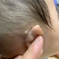 赤ちゃんの耳の裏にできもの しこり ８ヶ月になる赤ちゃんの耳を Yahoo 知恵袋