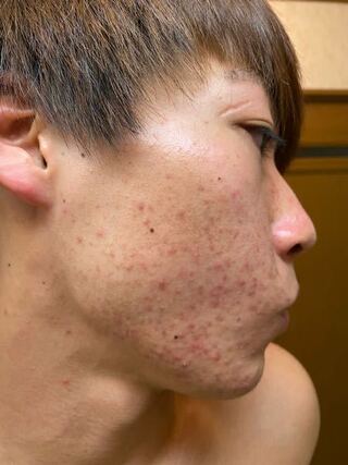 ニキビニキビがどうしても治りません そこらへんの人より努力している自 Yahoo 知恵袋