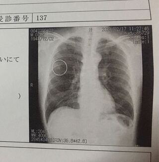 肺癌の疑いについて レントゲン写真あり 70代の父がレントゲンで Yahoo 知恵袋