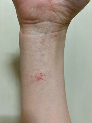 手首 ぶつぶつ 手首の湿疹がかゆい時の原因と対処法 ぶつぶつができた