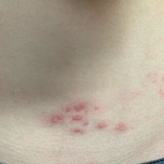 閲覧注意お腹と背中にできた赤いぶつぶつ痒いんですけど これはなんですか 他のと Yahoo 知恵袋