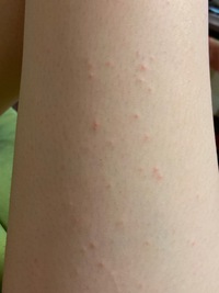 昨日から足に蕁麻疹があります 画像のような蕁麻疹が足全体に出ています Yahoo 知恵袋