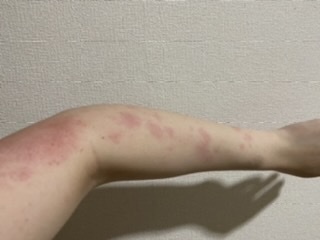 付ける 画家 称賛 肝臓 斑点 9milecreek Org