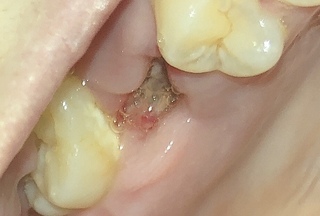 １週間前に上の奥歯を抜きました 痛みなどはありませんが白いものがあっ Yahoo 知恵袋