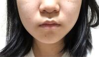 中学生です ほうれい線があります たぶん 数年間ずっとマスクだ Yahoo 知恵袋
