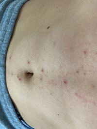 お腹にニキビのようなボツボツがあります 押すと芯が出てきますどうすれ Yahoo 知恵袋