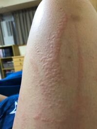 閲覧注意です 皮膚が3ヶ月前からおかしくて 少し掻いただけでもミ Yahoo 知恵袋