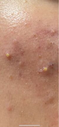 これは黄ニキビですか 潰さない方がいいですよね Yahoo 知恵袋
