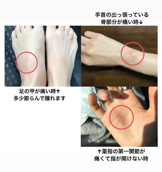 関節の痛み、腫れ、赤み、回帰性リウマチ - 25歳女性です。4年程前から 